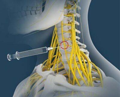 Stellate Ganglion Blocks