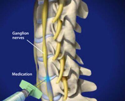 Stellate Ganglion Blocks