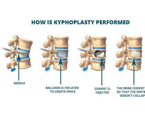 Kyphoplasty Procedure