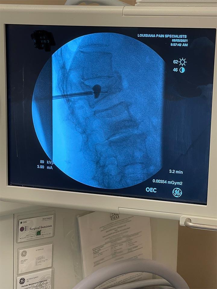 Kyphoplasty Procedure