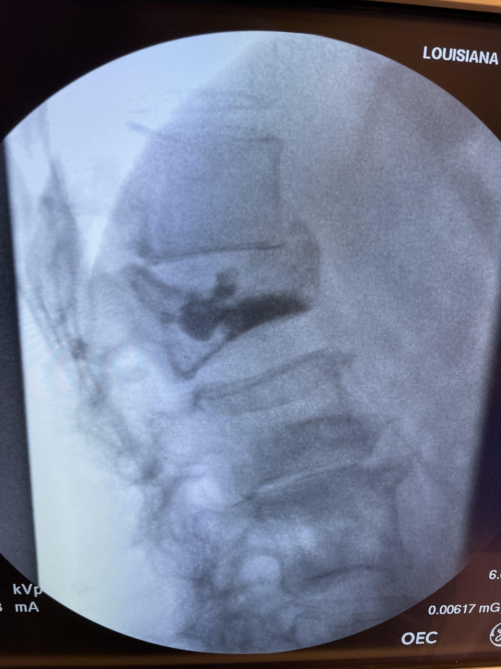Kyphoplasty Procedure