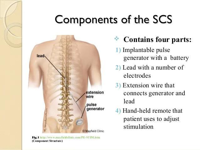 Spinal Cord Stimulation