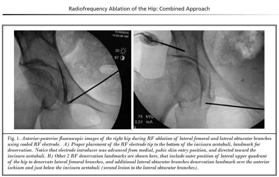 Chronic Hip Joint Pain