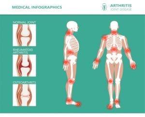 Arthritis