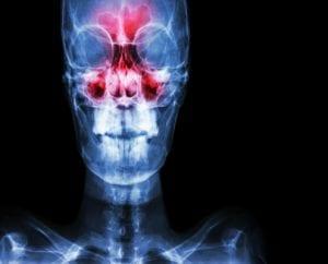 Sinus Headaches & Allergies