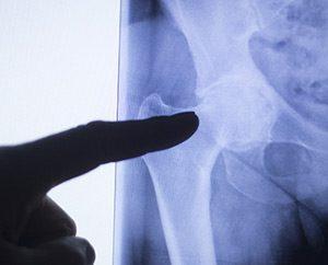 Chronic Hip Pain