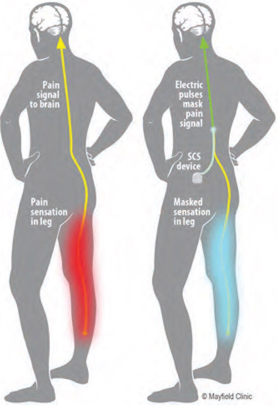 Spinal Cord Stimulation