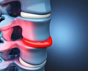 Herniated Disk