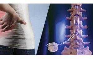 Spinal Cord Stimulation