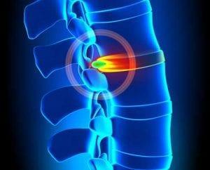 Herniated Disc