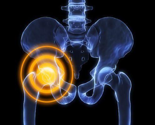 What Causes Hip Pain?