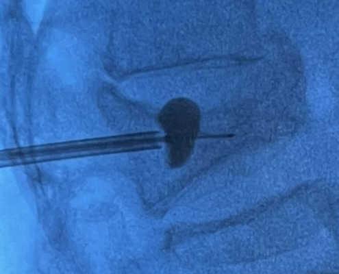Louisiana Pain Specialists and the Kyphoplasty Procedure