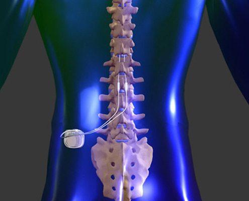 Louisiana Pain Specialists and Spinal Cord Stimulation