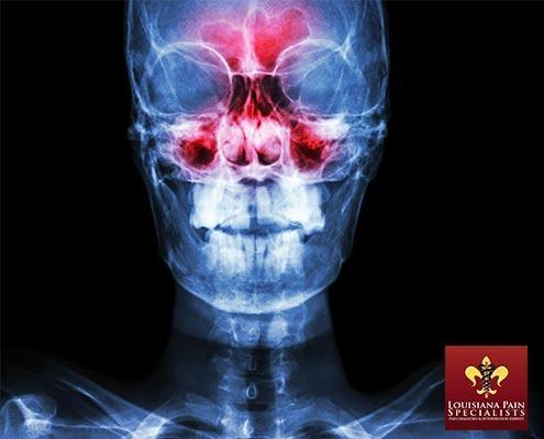 Sinus Headaches & Allergies