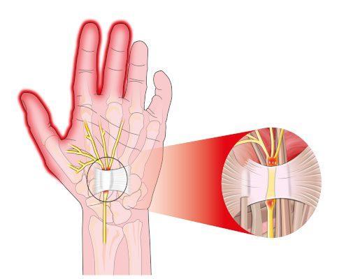 What is Carpal Tunnel Syndrome (CTS)?