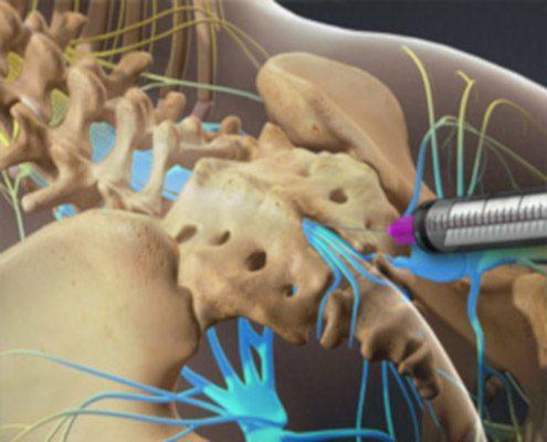 What Is A Caudal Epidural Steroid Injection?