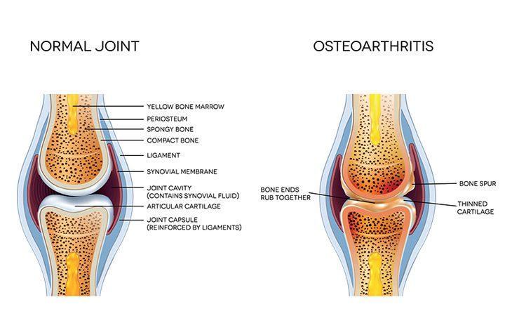 What is Arthritis, its cause, and treatments?