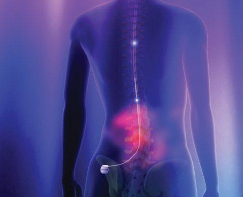Spinal Cord Stimulation Helps Limit Opiod Use in Chronic Pain Patients