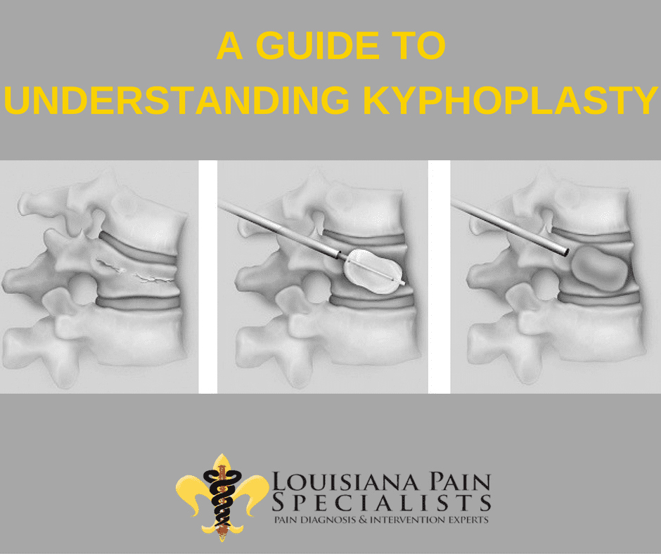 KyphoplastyA Guide To Understanding Kyphoplasty