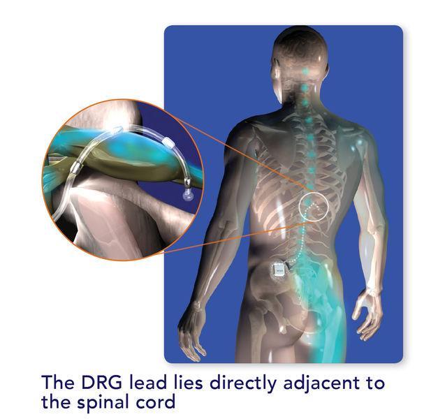 Chronic Intractable Pain