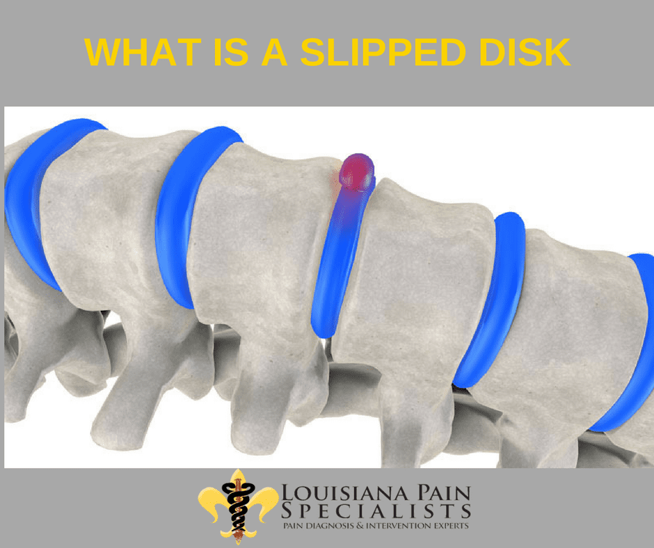 What Is A Slipped Disc?