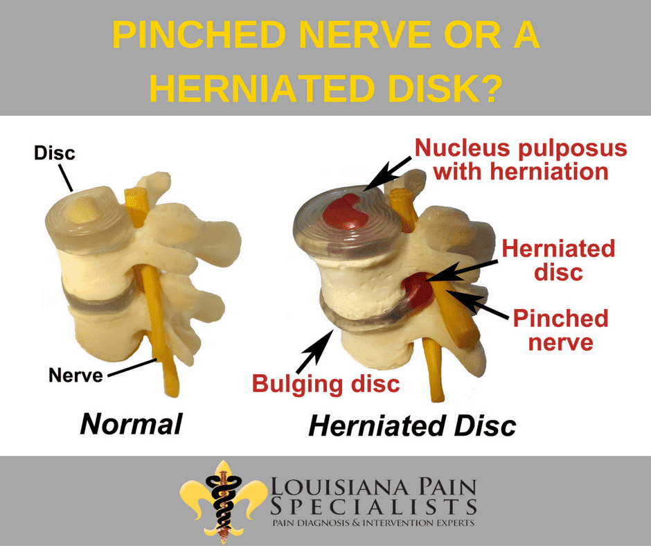 Is My Pain Caused By A Pinched Nerve Or A Herniated Disk?