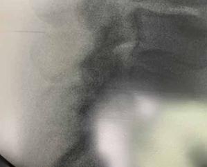 Lumbar spinal stenosis