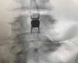 Lumbar spinal stenosis