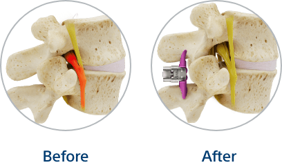 Before & after Vertiflex procedure (up close view of bones)